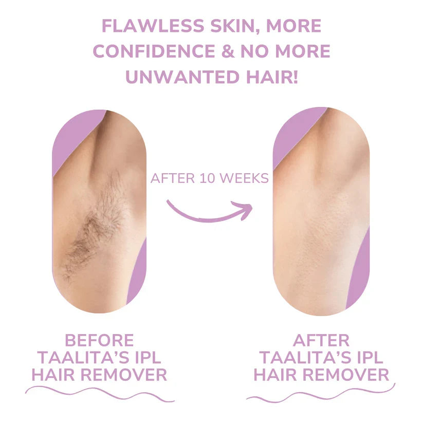 BeautyPlus IPL Hair Remover – Laser Hair Removal