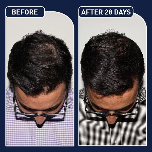 FEG™ Hair Growth Spray - بخاخ نمو الشعر
