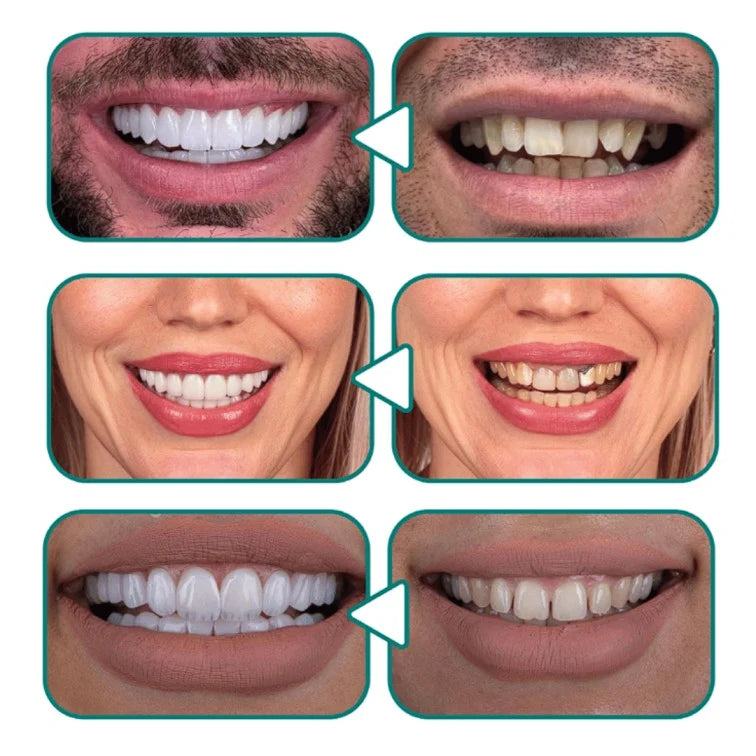 Snap-On Smile® – ابتسامة مثالية في ثوانٍ